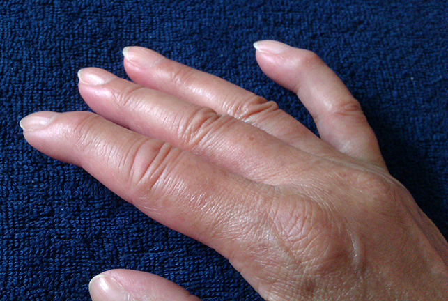 Causes Of Thickening Of Skin On Hands