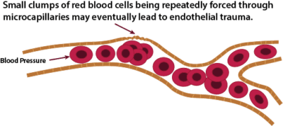 Systemic Sclerosis Pathogenesis – Is Blood Rheology the Key ...