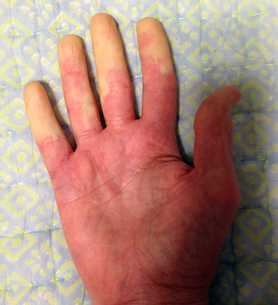 systemic scleroderma hands