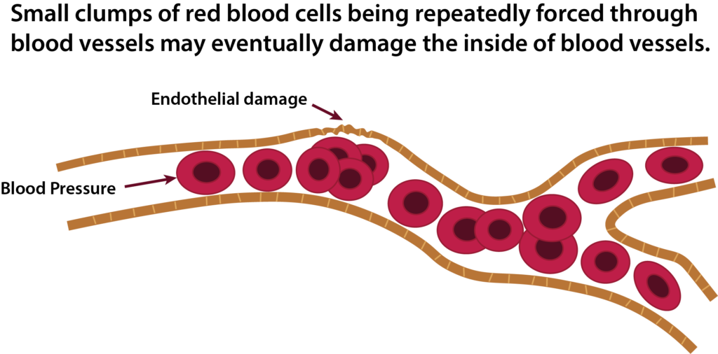 Therapeutic Plasma Exchange An Oil Change for Your Body? Scleroderma