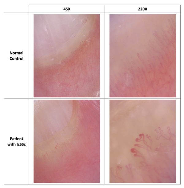 High Magnification Nailfold Capillary Examination For The Diagnosis Of Systemic Scleroderma